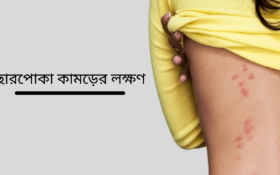 ছারপোকা কামড়ালে কি কি রোগ হয়? সম্পূর্ণ গাইড